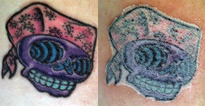 Before and after tattoo removal cream