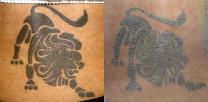 After one session of laser tattoo removal