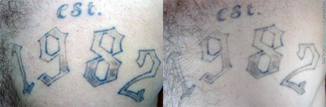 Before and after laser tattoo removal treatment