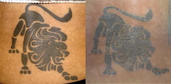 Tattoo Removal Process & Cost ULTIMATE GUIDE